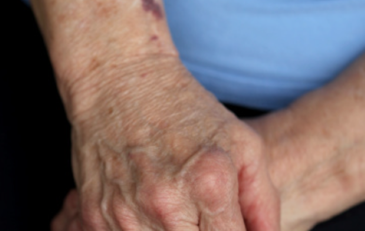 What Causes Easy Bruising In Seniors?