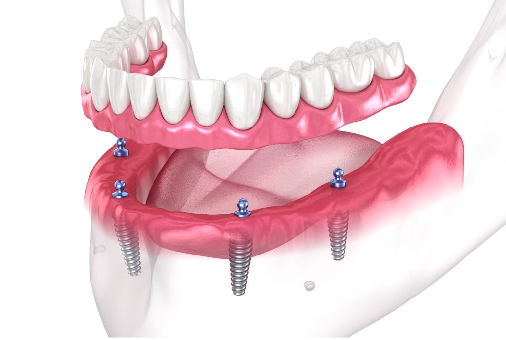 Reclaiming-Confidence-All-On-4-Dental-Implants-For-Seniors-1
