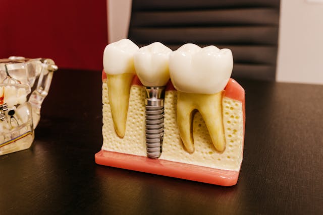 Reclaiming Confidence All-On-4 Dental Implants For Seniors