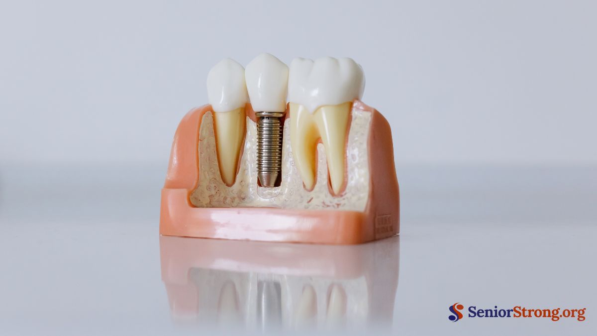 7 Best Implant Options for Seniors
