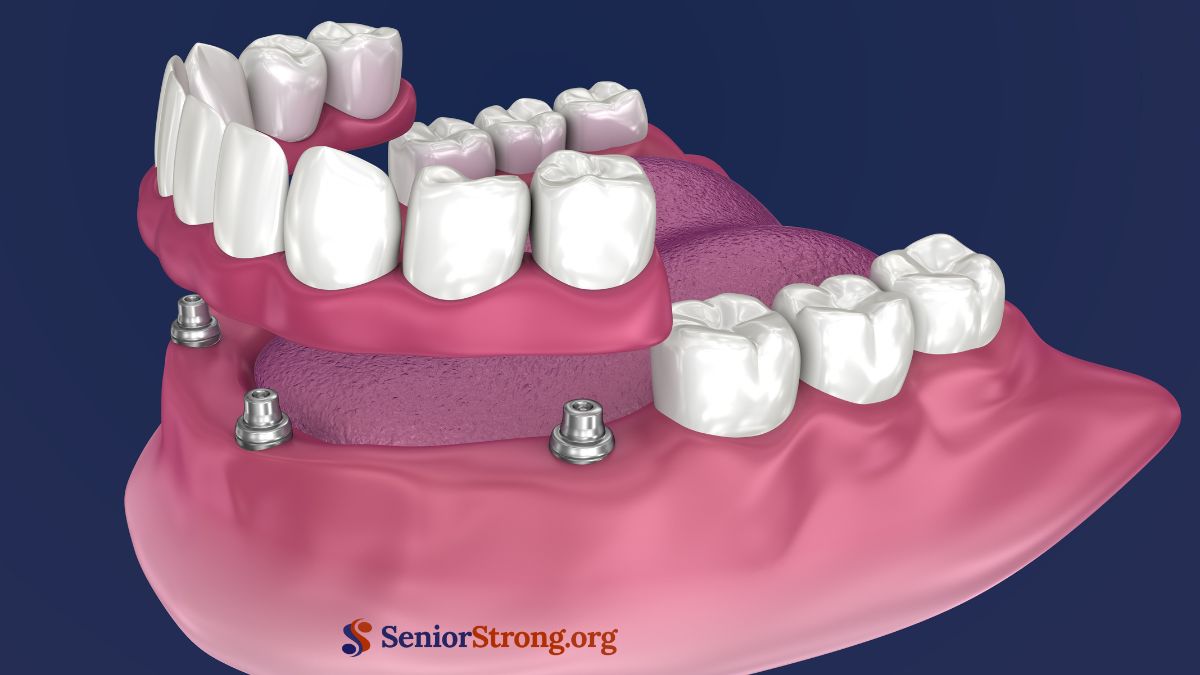 Snap-In Dentures