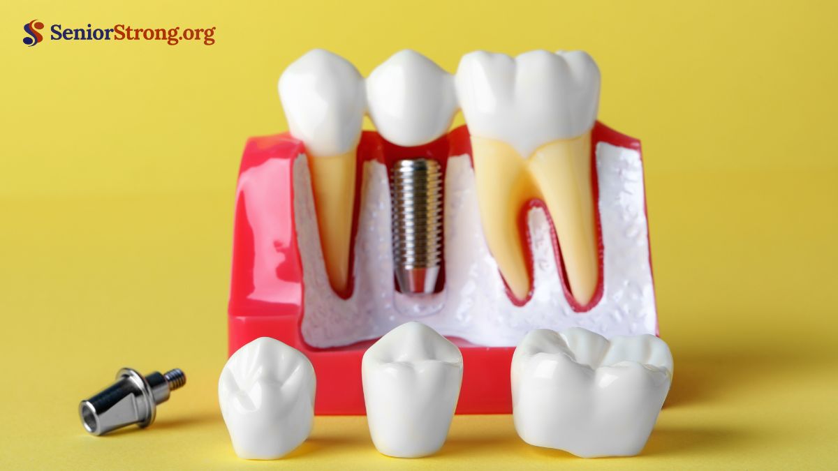 Traditional Dental Implants