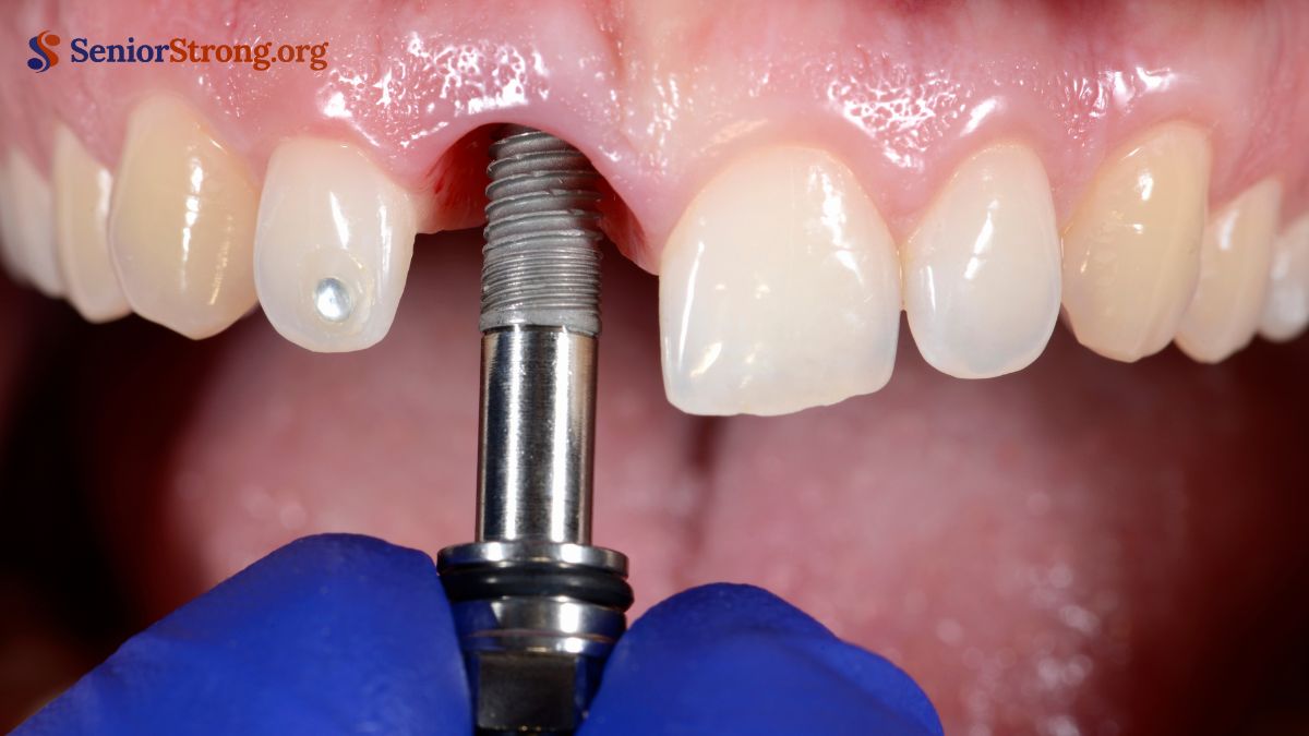 Why Choose Dental Implants for Seniors
